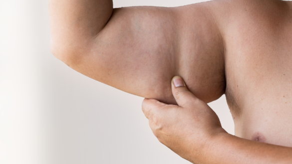 Var tredje barn i Europa lider av övervikt eller fetma